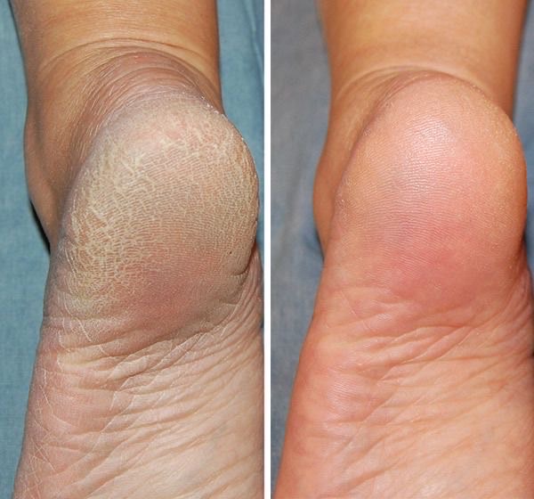PEDİKÜR